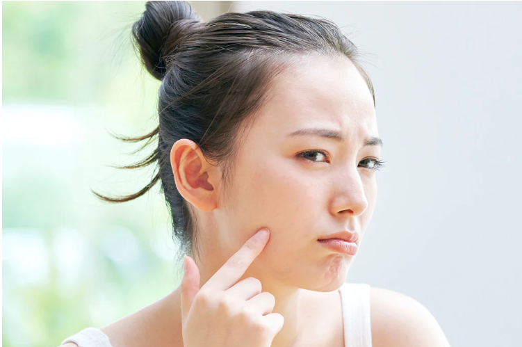 以為天氣凍少出油？錯啦！冬天痘痘肌護理攻略