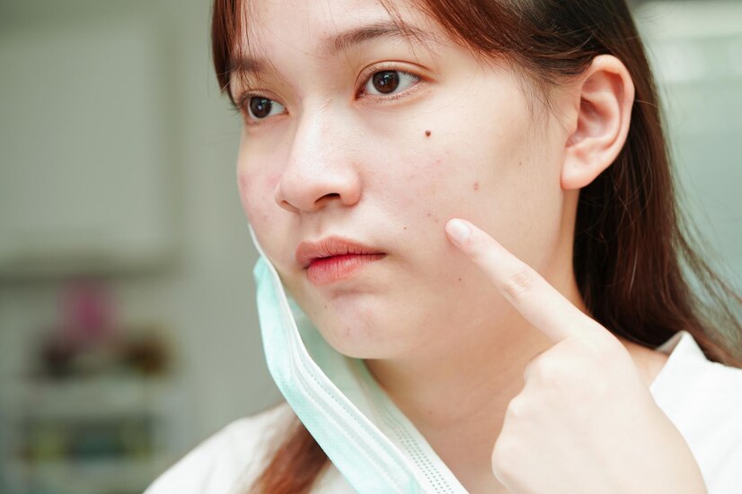 【護膚迷思】勤力啲清潔皮膚，能夠解決痘痘問題？