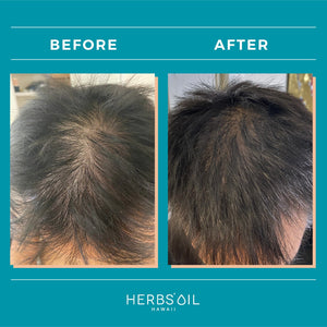 油頭頭皮救星, 油頭救星, 油頭急救, 重生洗頭水 Hair Regenerating Treatment Shampoo, 護髮素, 壓力脫髮, 甩頭髮